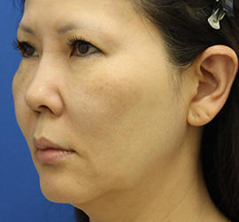 50代女性のシワ・たるみ Before 症例写真