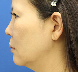 50代女性の顔の脂肪吸引  Before 症例写真