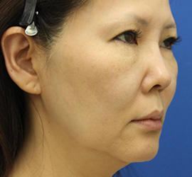 50代女性の顔の脂肪吸引  Before 症例写真