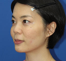 30代女性のダブロ ゴールド After 症例写真