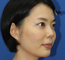 30代女性のダブロ ゴールド After 症例写真