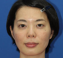 30代女性のダブロ ゴールド Before 症例写真