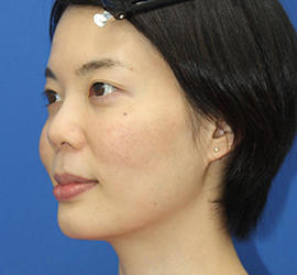 30代女性のダブロ ゴールド Before 症例写真