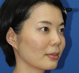 30代女性のダブロ ゴールド Before 症例写真