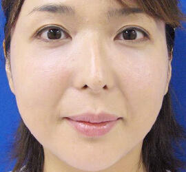 30代女性のヒアルロン酸注射  After 症例写真