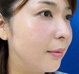 30代女性の目の下のクマ治療 After 症例写真