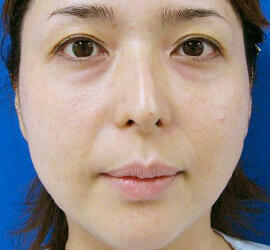 30代女性のヒアルロン酸注射  Before 症例写真