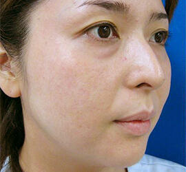 30代女性の目の下のクマ治療 Before 症例写真