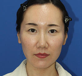 30代女性のダブロ ゴールド After 症例写真