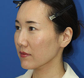 30代女性のダブロ ゴールド After 症例写真