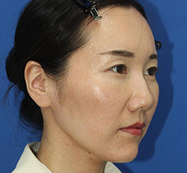 30代女性のダブロ ゴールド After 症例写真