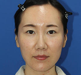 30代女性のダブロ ゴールド Before 症例写真