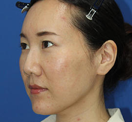 30代女性のダブロ ゴールド Before 症例写真