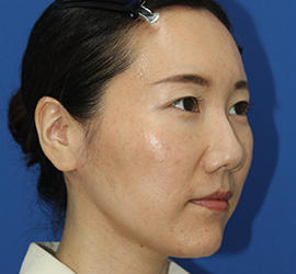 30代女性のダブロ ゴールド Before 症例写真