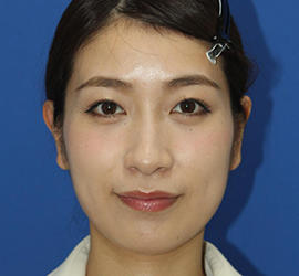 20代女性のダブロ ゴールド After 症例写真