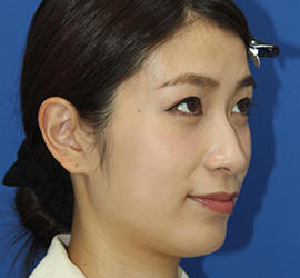 20代女性のダブロ ゴールド After 症例写真