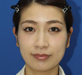 20代女性のダブロ ゴールド Before 症例写真