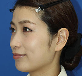 20代女性のダブロ ゴールド Before 症例写真