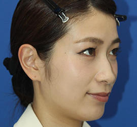 20代女性のダブロ ゴールド Before 症例写真