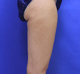 30代女性のダブロ ゴールド After 症例写真