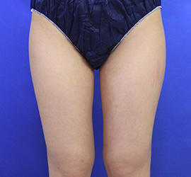 20代女性のダブロ ゴールド After 症例写真