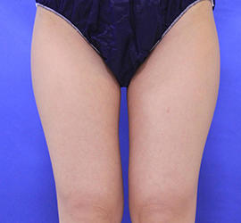 20代女性のダブロ ゴールド Before 症例写真