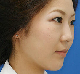 20代女性の鼻の整形 After 症例写真