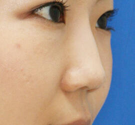 20代女性のヒアルロン酸注射（鼻形成） After 症例写真