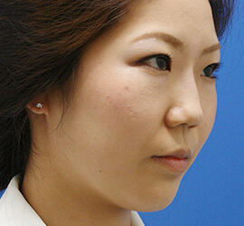 20代女性の鼻の整形 Before 症例写真