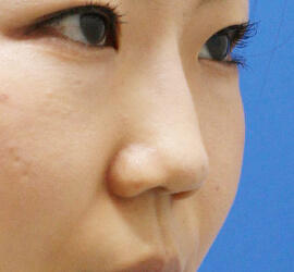 20代女性のヒアルロン酸注射（鼻形成） Before 症例写真