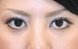 20代女性のヒアルロン酸注射  After 症例写真