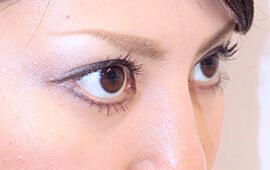 20代女性の目の下のクマ治療 After 症例写真