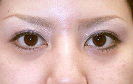 20代女性のヒアルロン酸注射  Before 症例写真