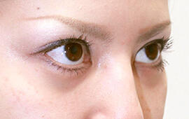 20代女性の目の下のクマ治療 Before 症例写真