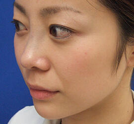 20代女性の鼻の整形 After 症例写真