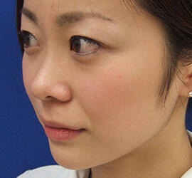 20代女性の鼻の整形 Before 症例写真