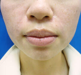 30代女性のシワ・たるみ After 症例写真