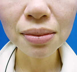 30代女性のシワ・たるみ Before 症例写真