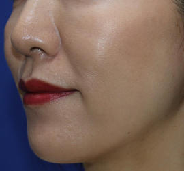 30代女性の After 症例写真