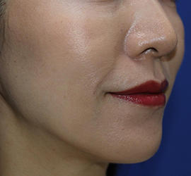 30代女性のシワ・たるみ After 症例写真