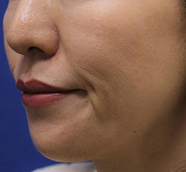 30代女性の Before 症例写真