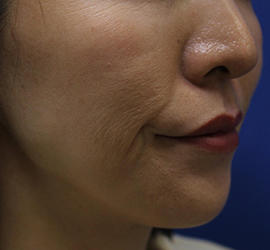 30代女性のシワ・たるみ Before 症例写真