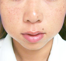 20代女性のシミ・そばかす Before 症例写真