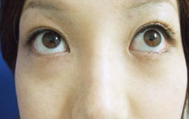 30代女性のシミ・そばかす After 症例写真