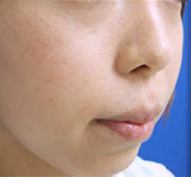 30代女性のシミ・そばかす After 症例写真