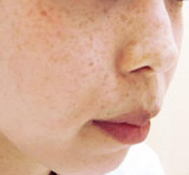 30代女性のシミ・そばかす Before 症例写真