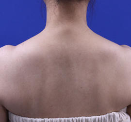 30代女性のボトックス（美肩・肩こり解消） After 症例写真