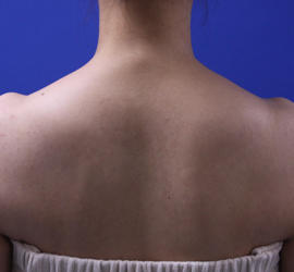 30代女性のボトックス（美肩・肩こり解消） Before 症例写真