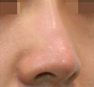 20代女性のヒアルロン酸注射（鼻形成） After 症例写真