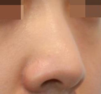 20代女性の鼻の整形 Before 症例写真